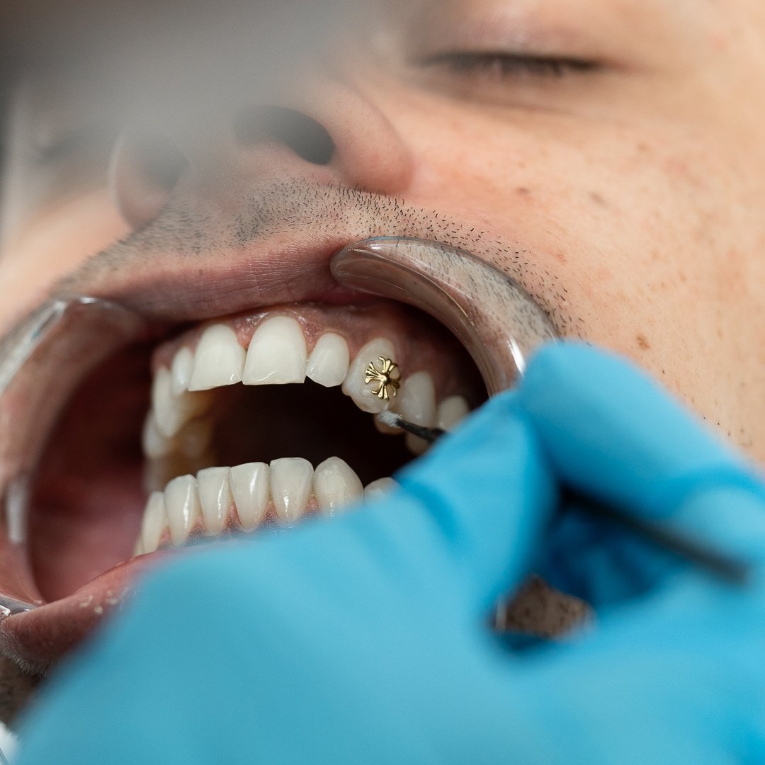 Close-up of a person receiving a dental procedure on a tooth with a gold adornment, using dental tools and gloves.