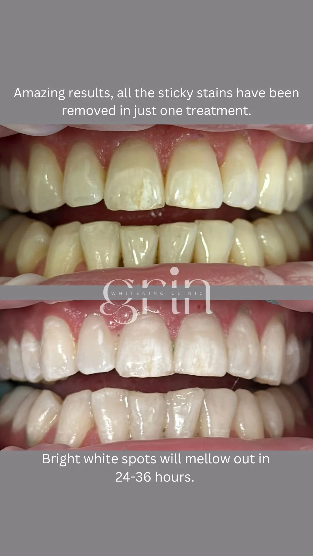 Grin-Whitening-Clinic-Results-Before:After-10.jpg