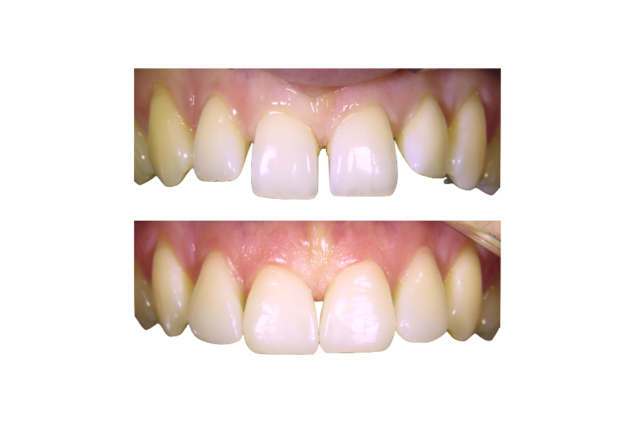 veneers-fezer Kopie.png