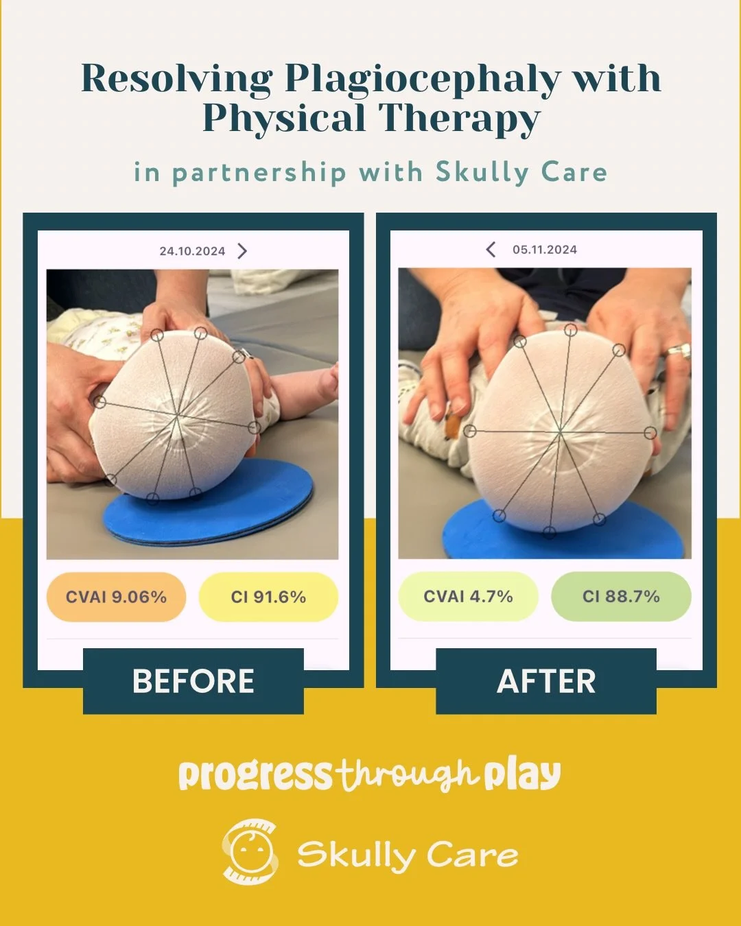 Big news for parents! Scroll down for a special discount 🥳
Skully Care just released a parent-facing app that lets you take a guided photo of your baby&rsquo;s head shape and get immediate results &mdash; all from home and for a super small cost (se