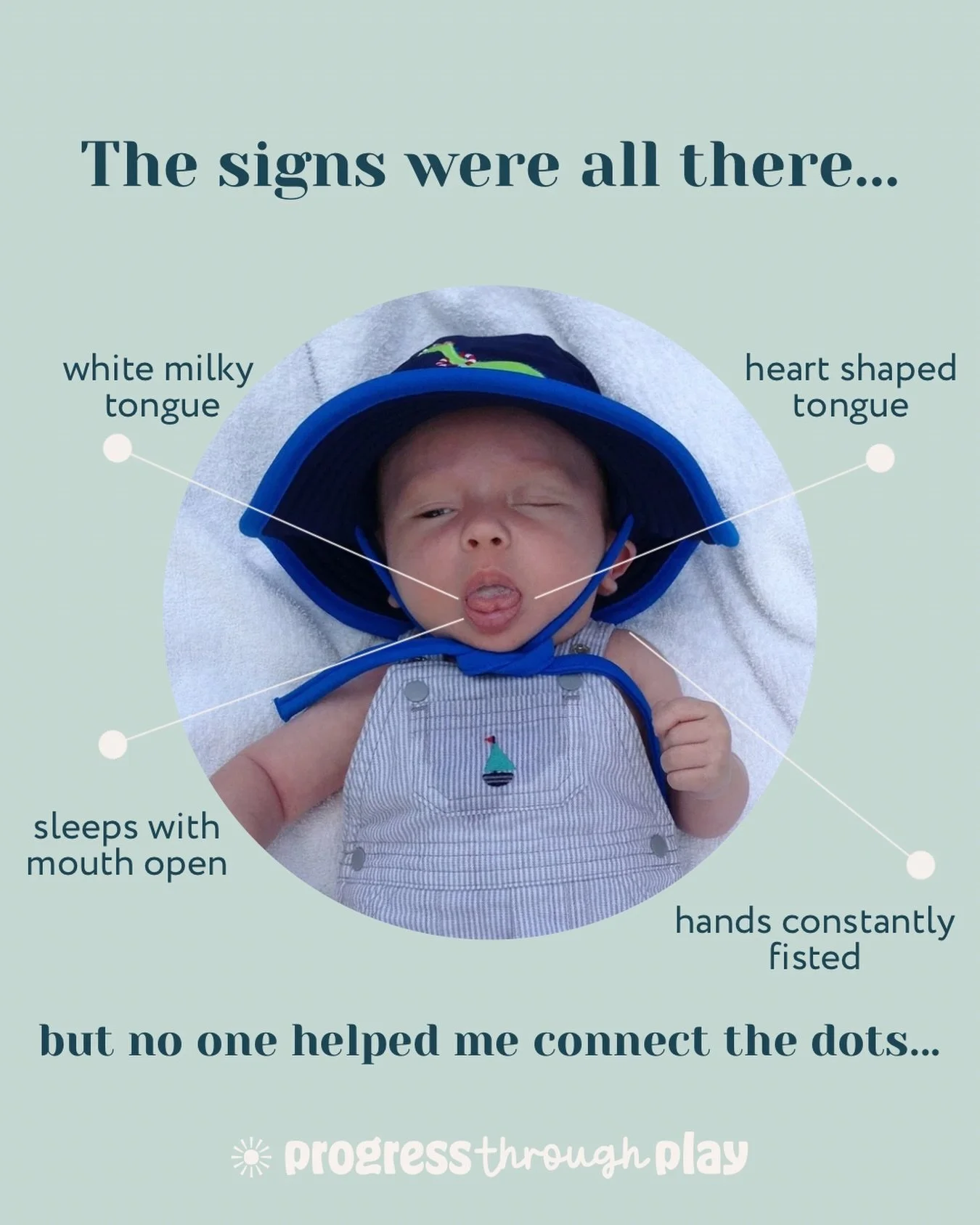The physical signs of my son&rsquo;s tongue tie and oral dysfunction were quite obvious&hellip;but at the time (12 years ago) I didn&rsquo;t have anyone knowledgeable in oral function to show me how it was all connected to his symptoms: reflux, diffi