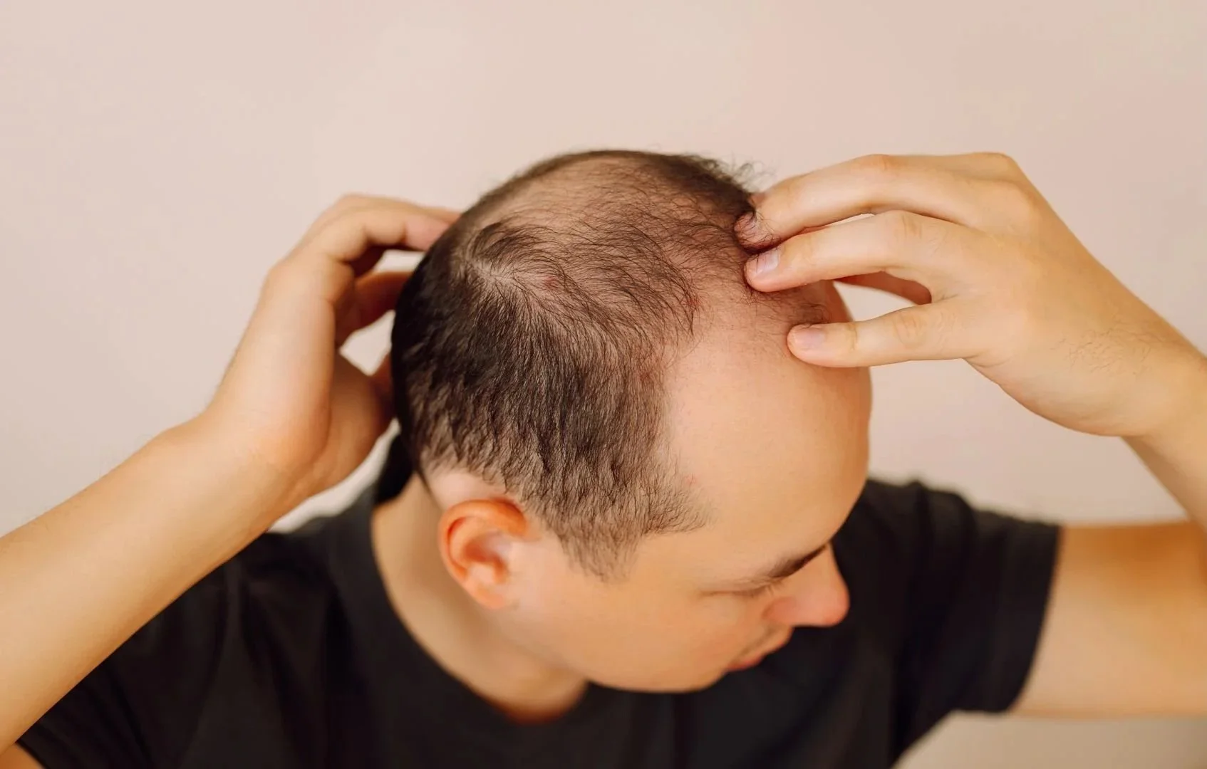 Man experiencing hair loss and touching his head