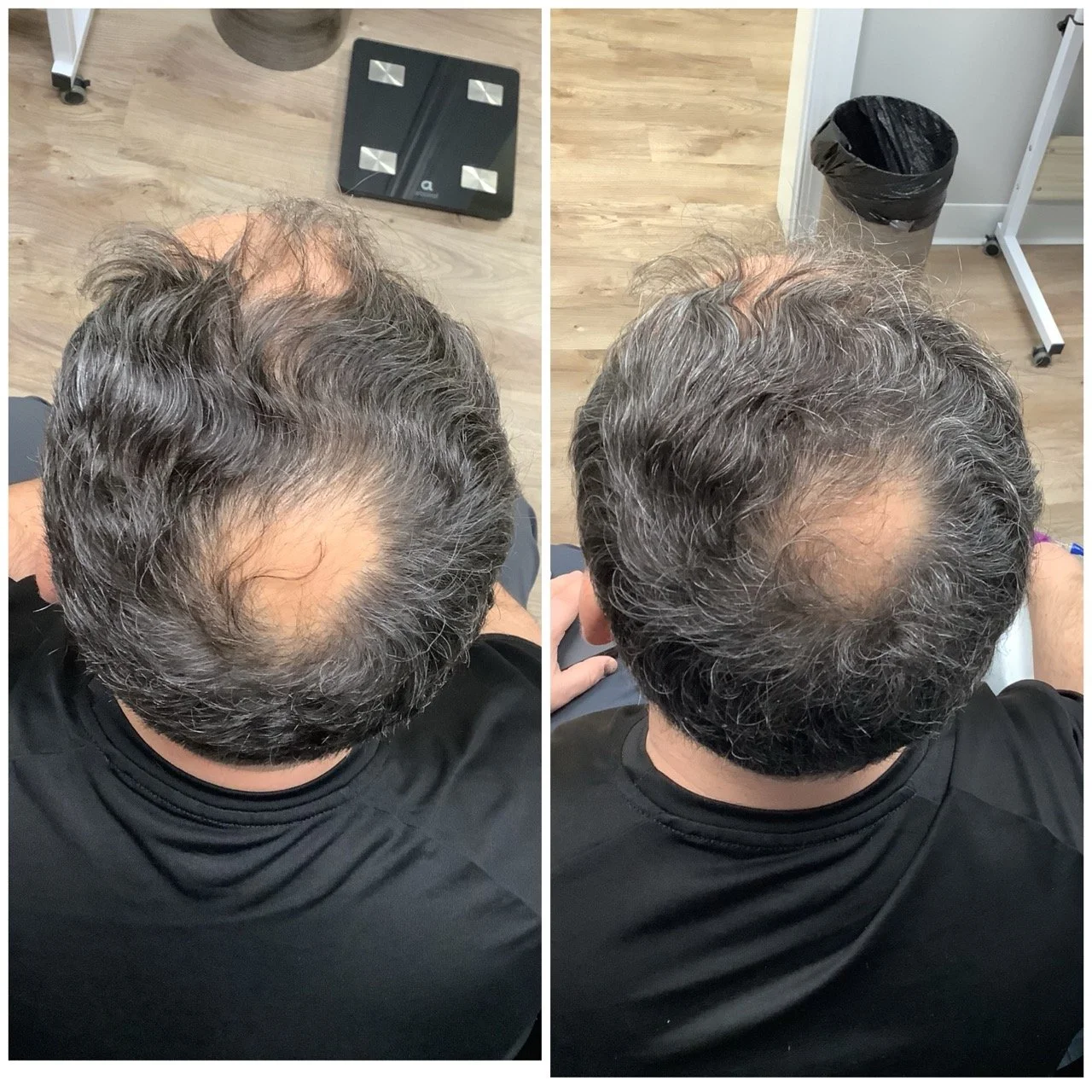 Before and after hair restoration man hair loss kirtland ohio