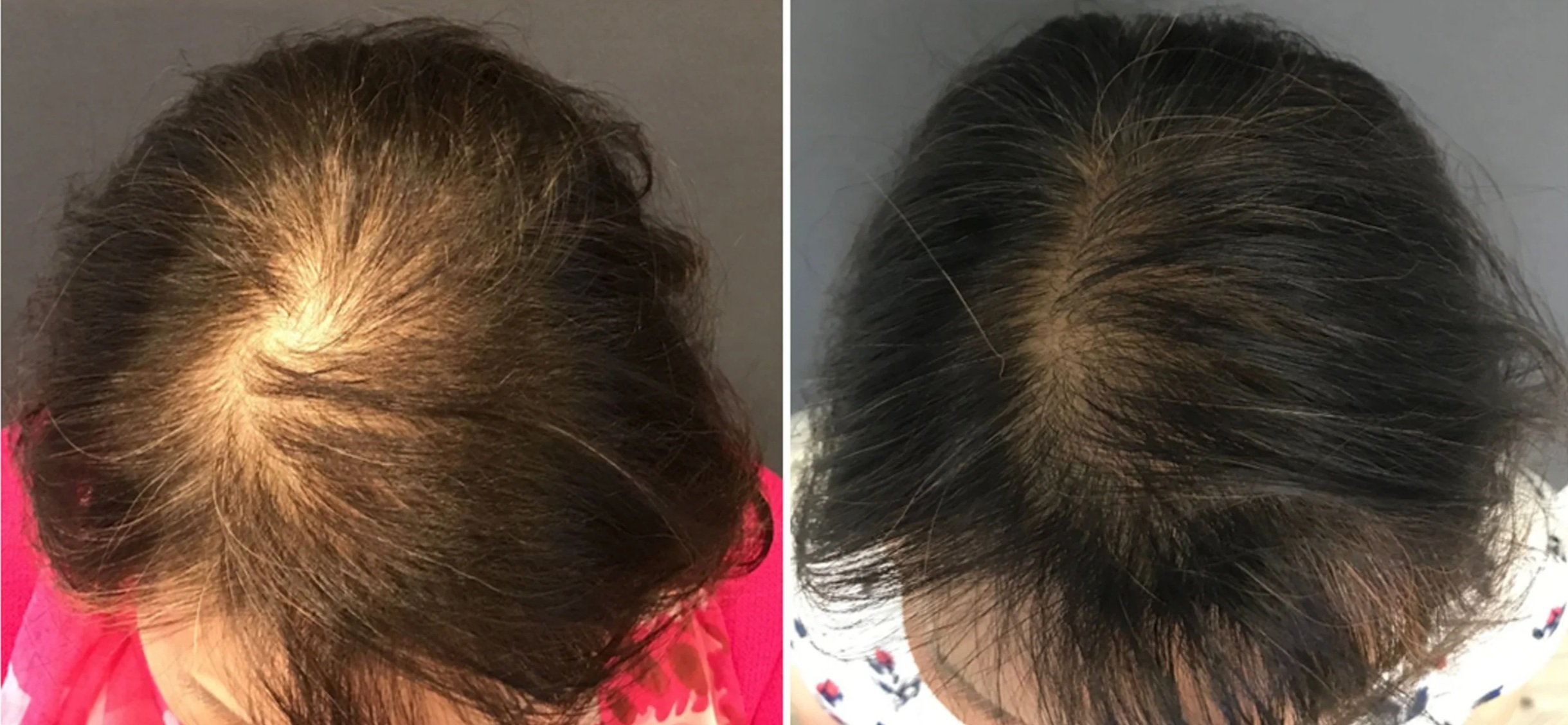 Before and after hair treatment woman