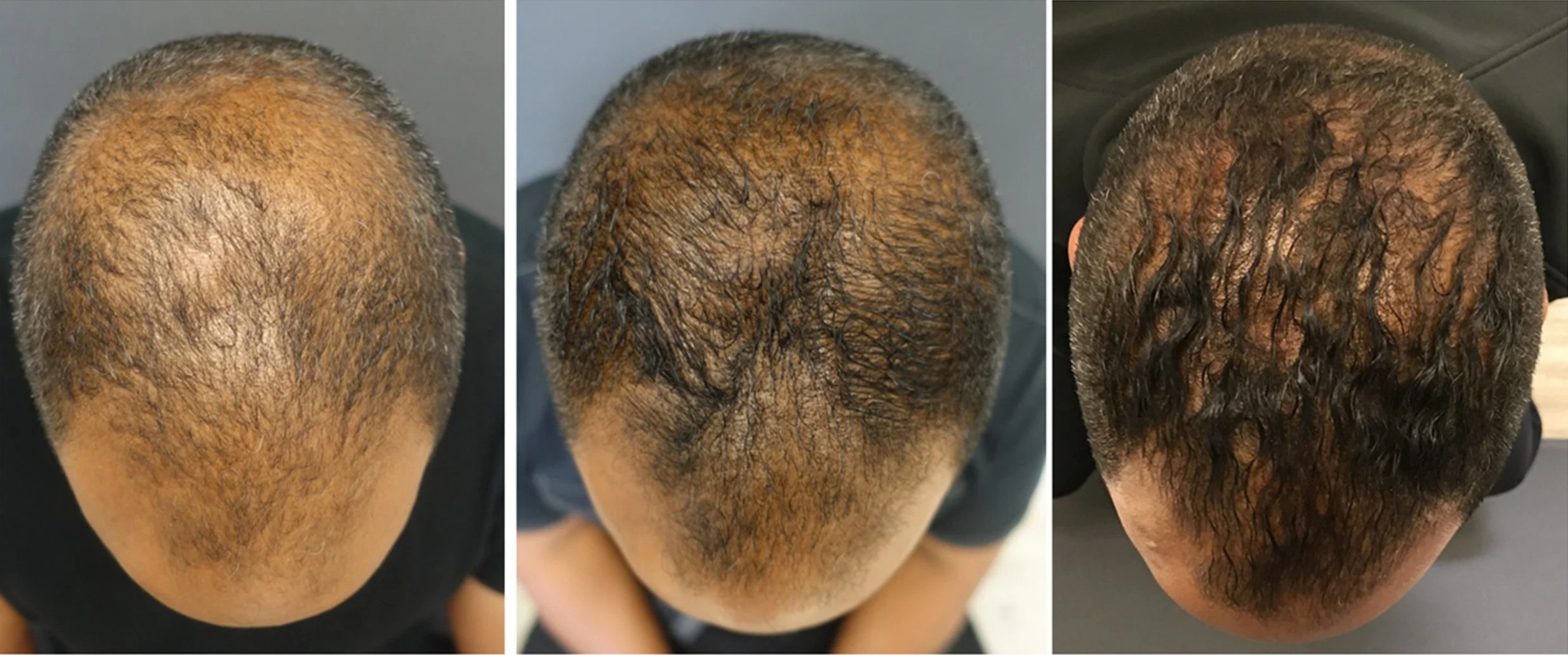 before and after hair treatment man kirtland ohio