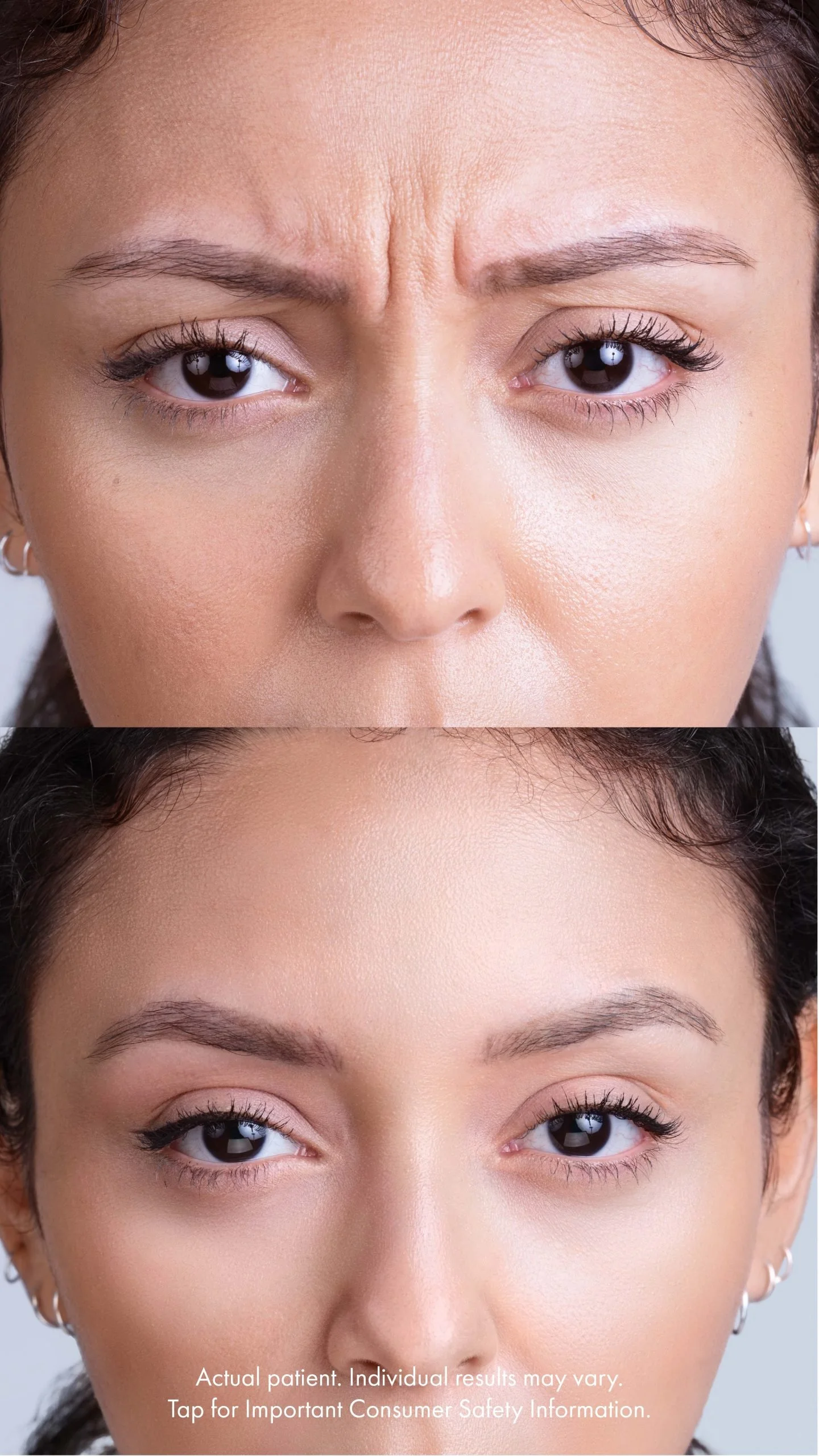 Frown lines vs. no frown lines after Xeomin