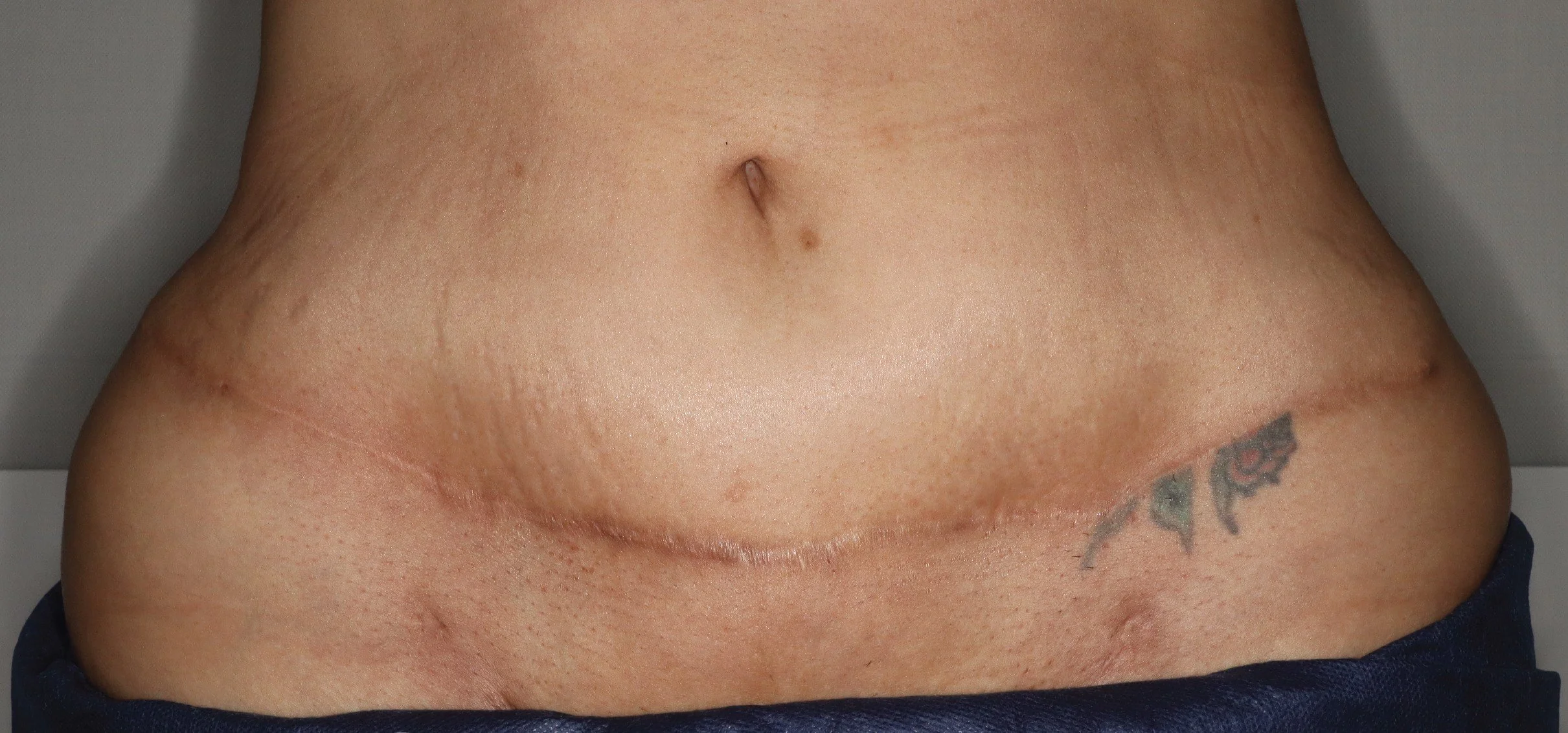 Chemical peel for a tummy tuck scar, before photo in kirtland ohio