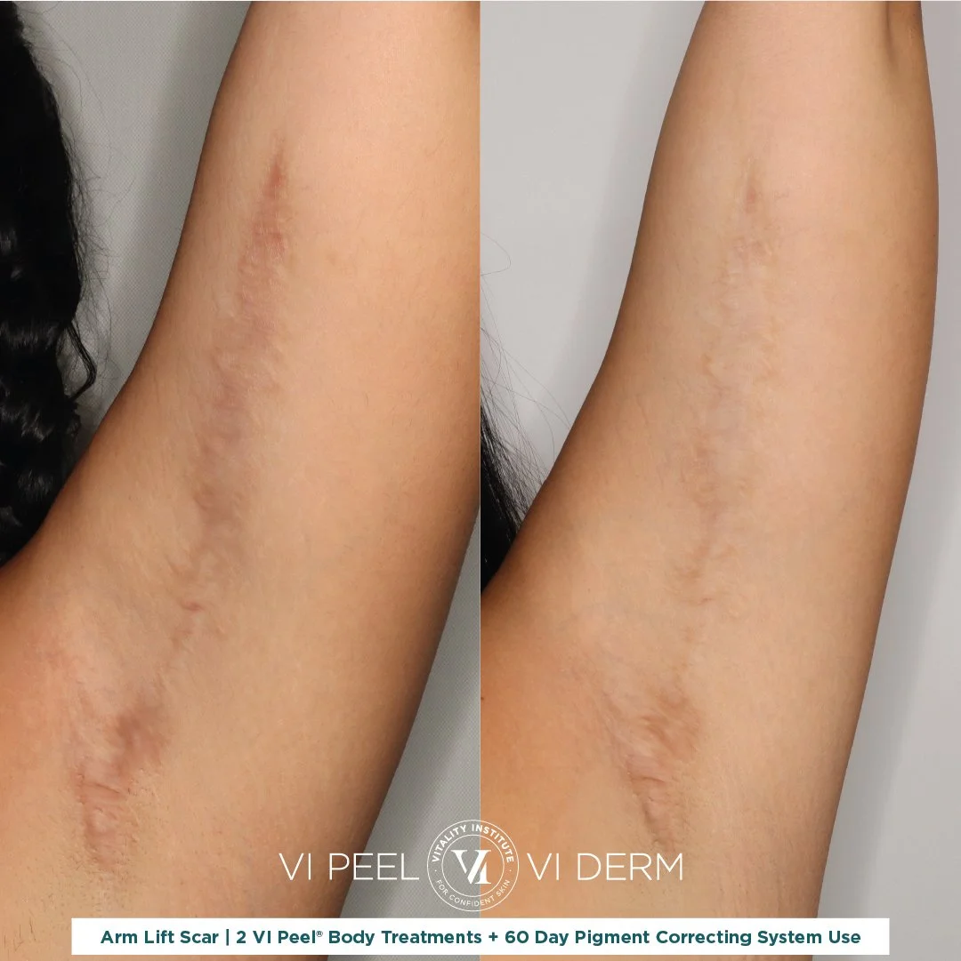 before and after chemical peel photo from scaring due to arm lift, showing reduced scarring and improved skin appearance.