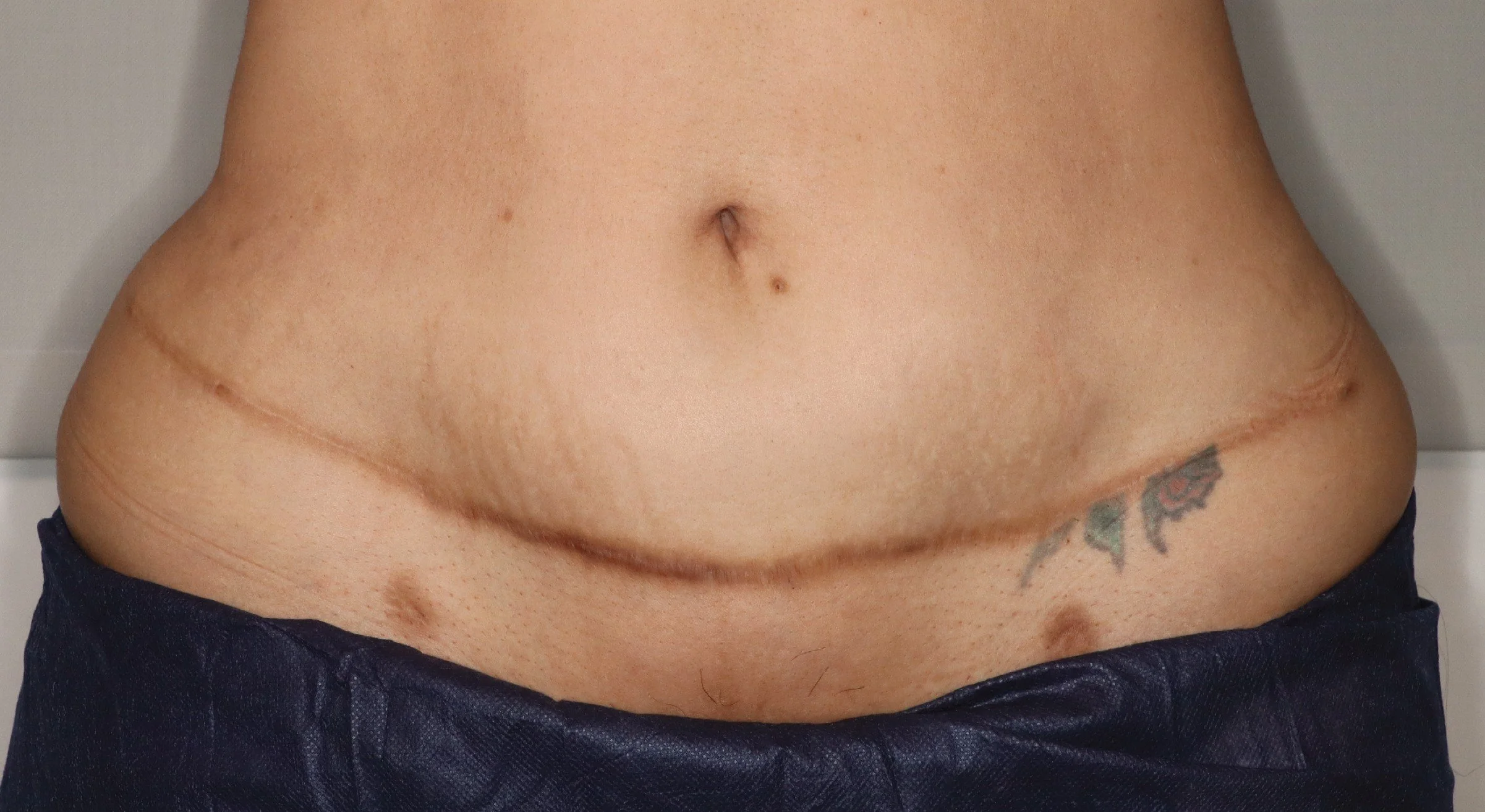 Chemical peel for a tummy tuck scar, after 2 treatments in kirtland ohio