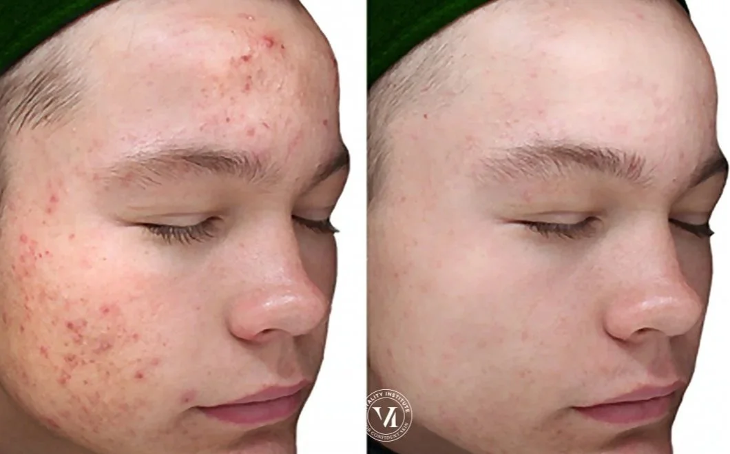 before and after of female of chemical peel treatment for acne scaring, showing significant reduction in acne and skin redness in kirtland ohio