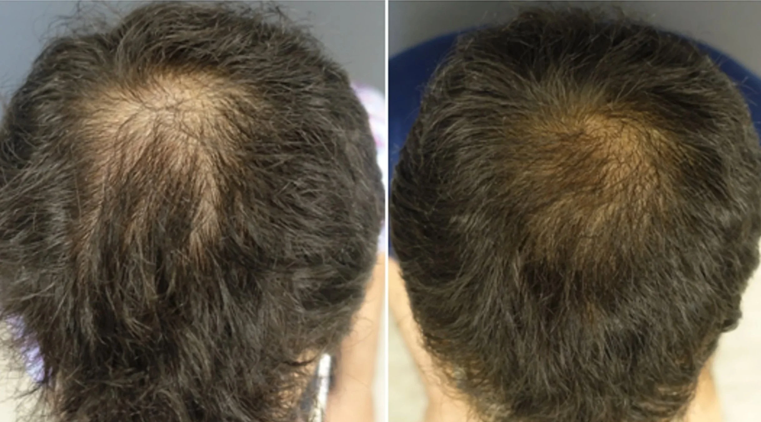 Before and after hair treatment balding back of head kirtland ohio