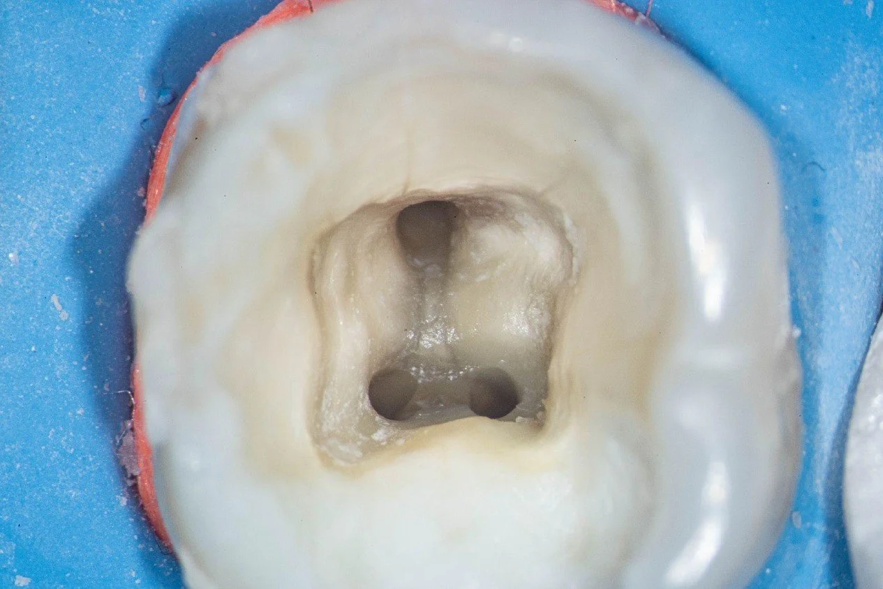 What Happens If an Infected Tooth Is Left Untreated?