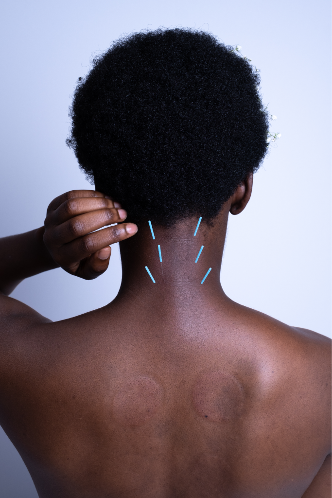Facial Gua Sha On Health Magazine — Emily Grace Acupuncture  New York  based acupuncture clinic specializing in women of color acupuncture,  fertility and menstrual health, Traditional Chinese Medicine and more