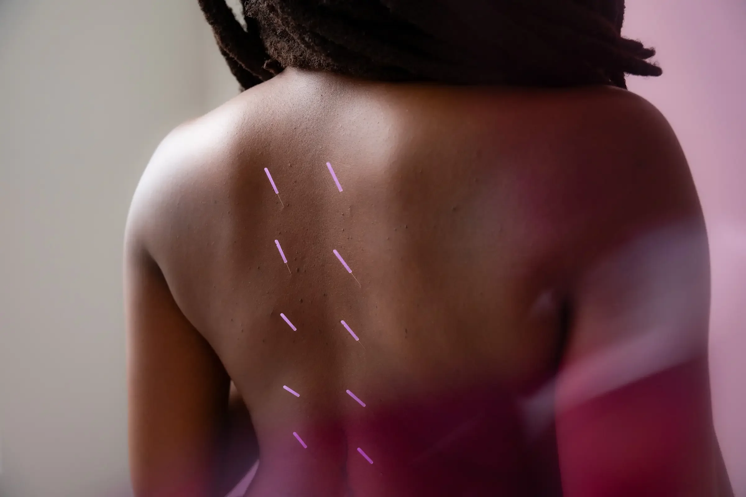A person receiving acupuncture treatment on the neck and shoulder area, with acupuncture needles inserted into the skin.