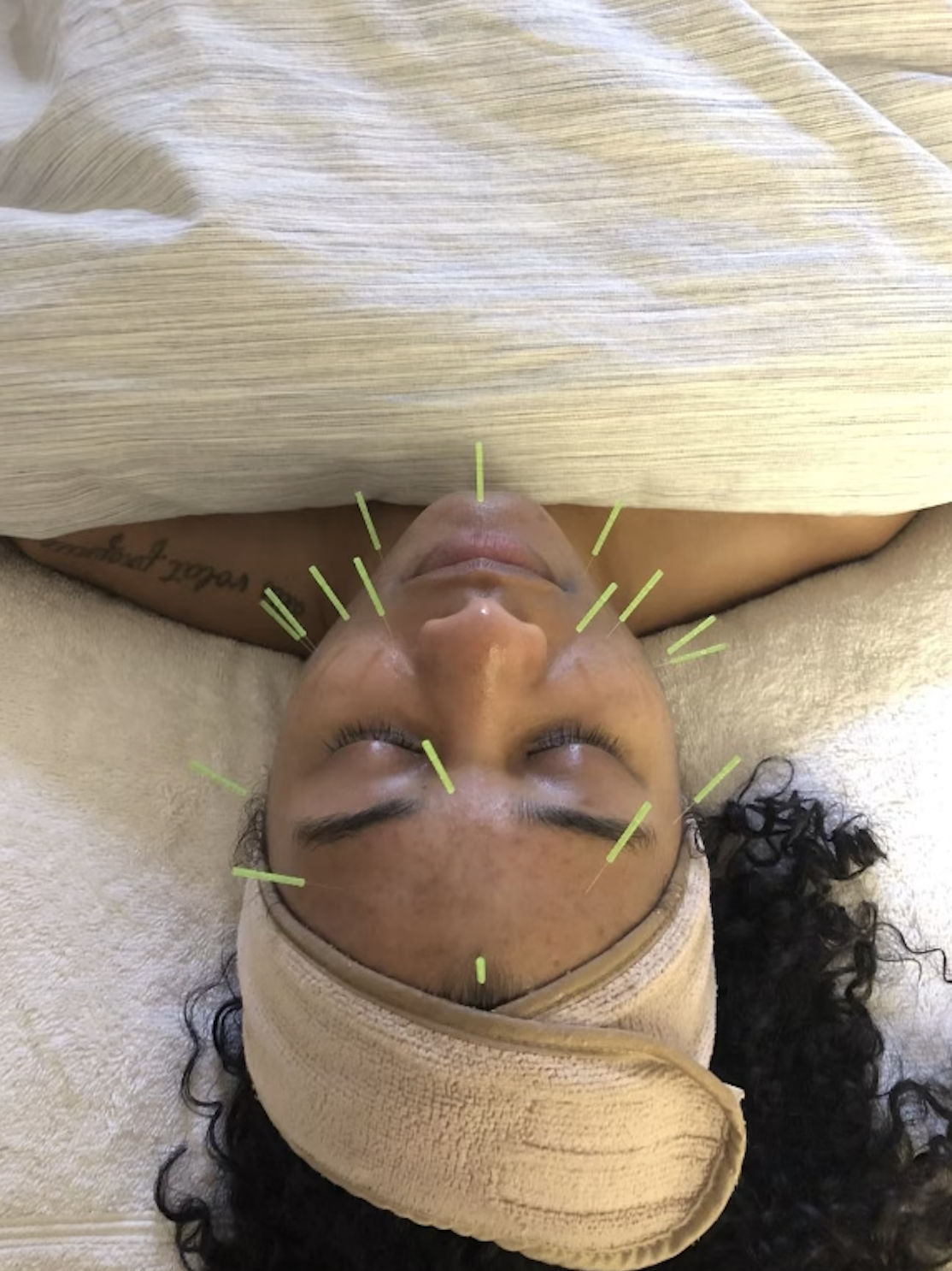 Is facial acupuncture the new Botox?