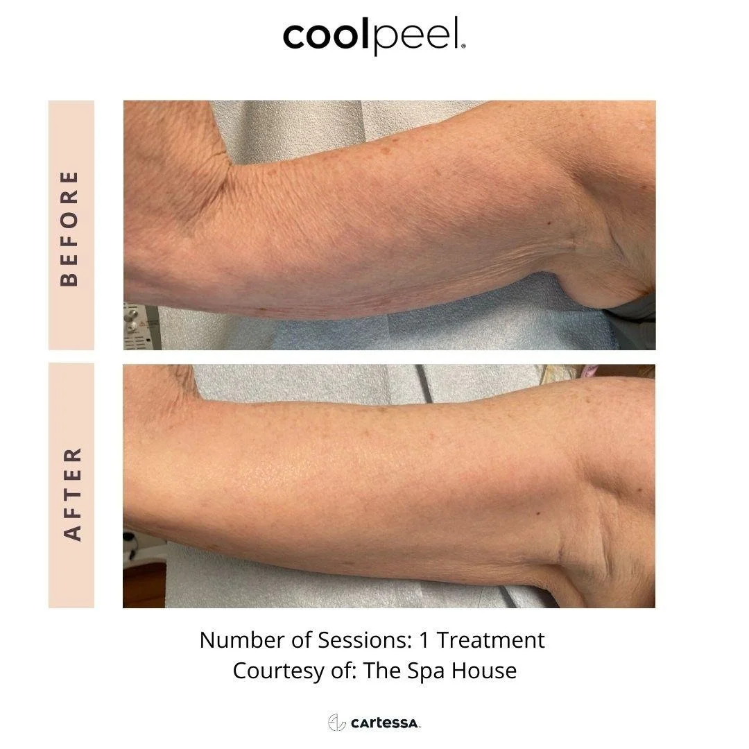 The Spa House CoolPeel CO2 Laser before and after, targeting crepey skin and improving skin texture.