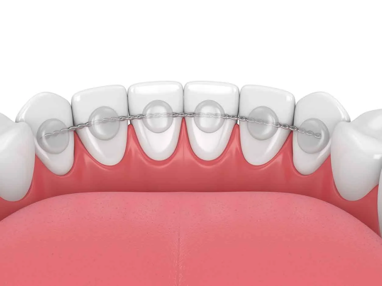 Retainers For Teeth A Comprehensive Teeth Retention Guide