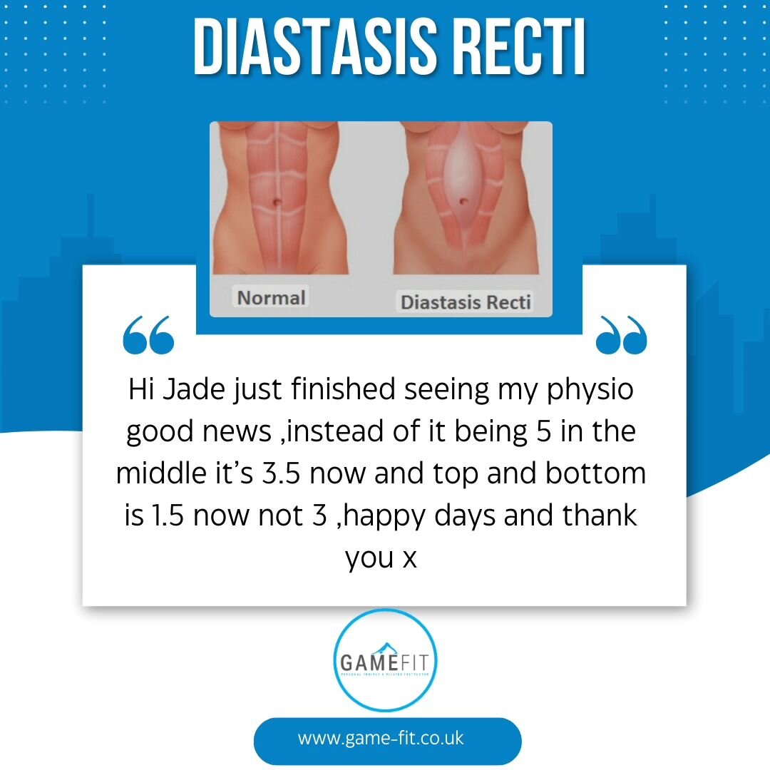 Just received this message from a client of mine suffering with Diastasis Recti, we have been training since mid November and she has got stronger and stronger each session. This morning she saw her Physio and what a difference! 

What is Diastasis R