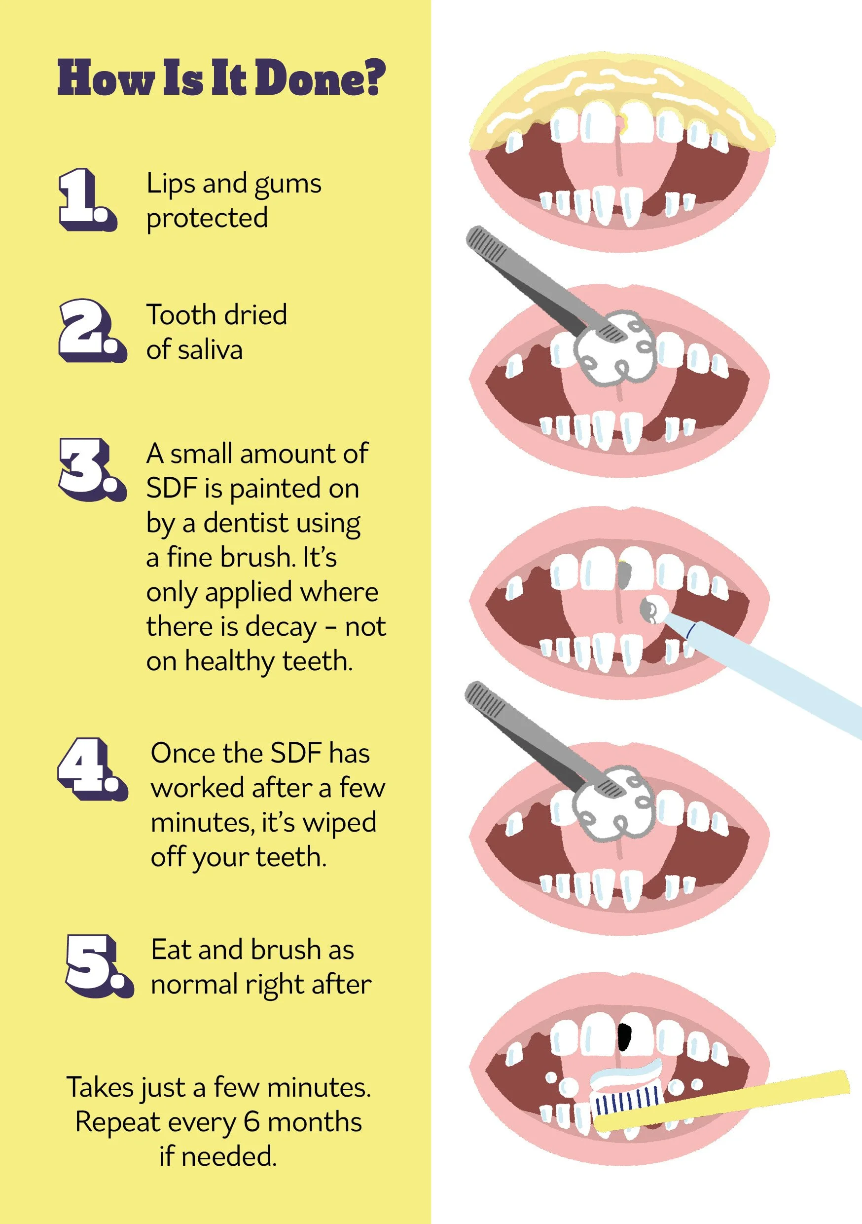 Strpping Tooth Stopping Tooth Decay | Leaflet — Emseeitch