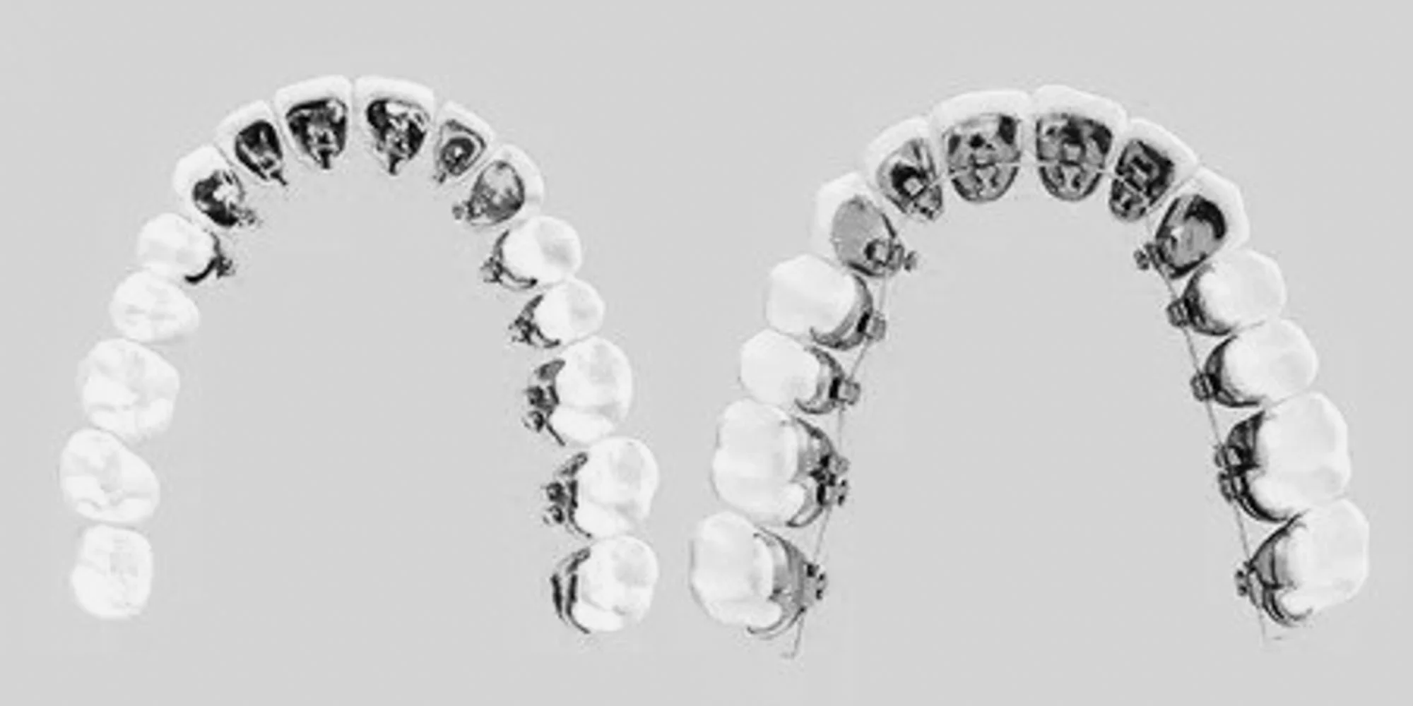 Hvordan er prosedyren for incognito tannregulering i Oslo?