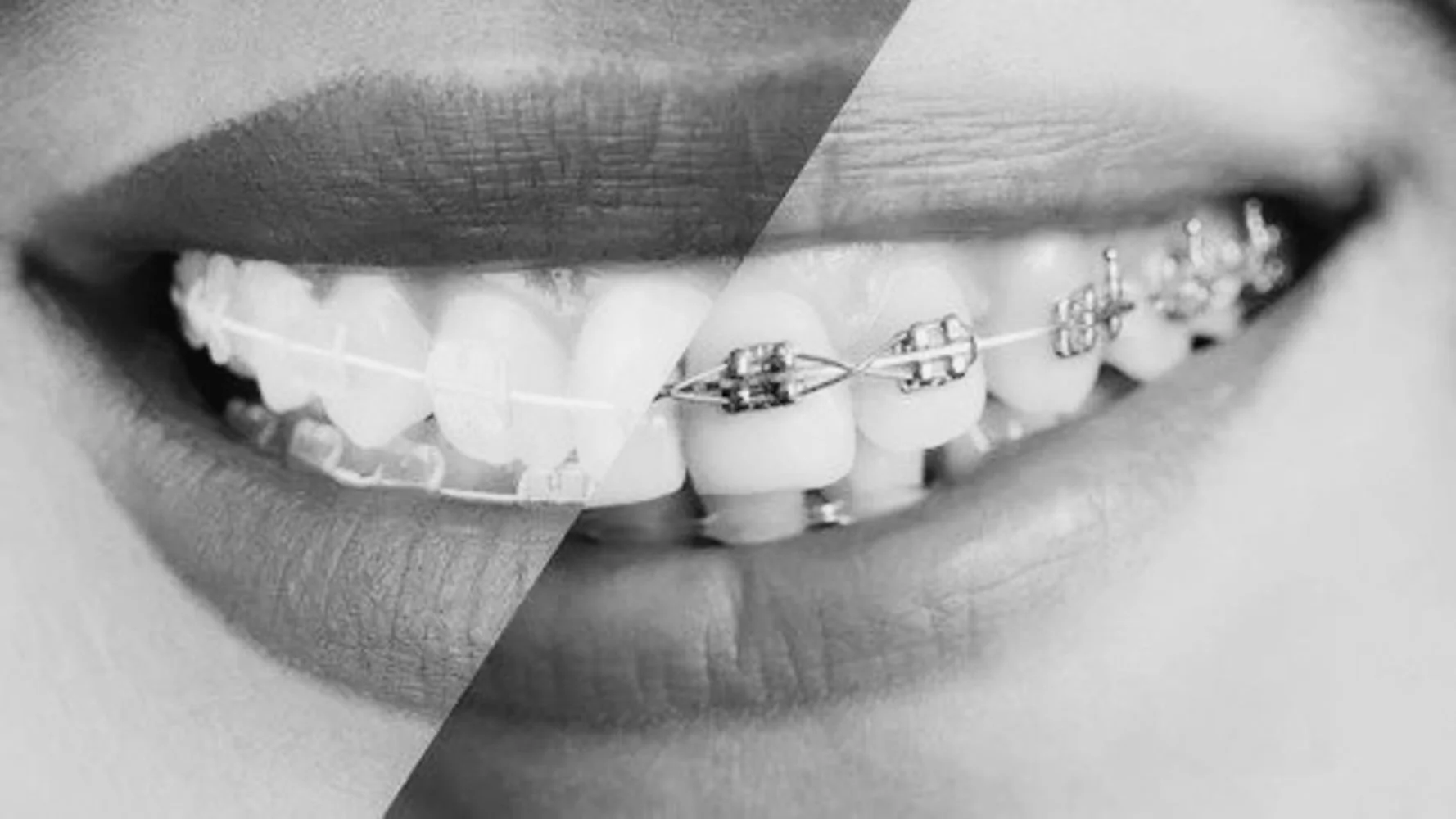 Kan hvit tannregulering bidra til å forbedre utseendet til tennene?