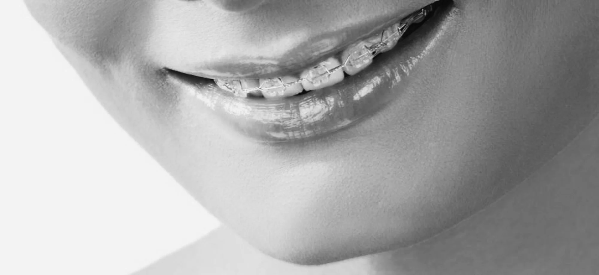 Hva er gjennomsiktig tannregulering og hvordan fungerer det?