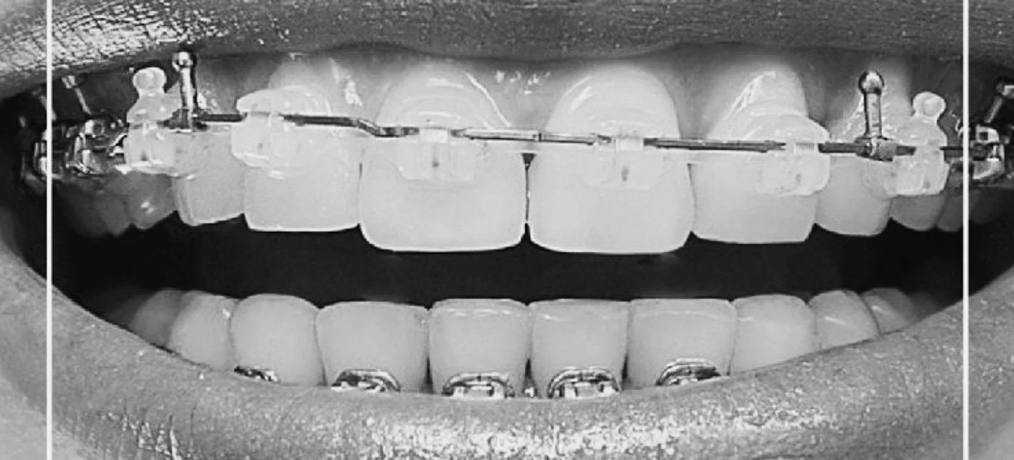 Hva er hekleseler og hvordan brukes de i kjeveortopedi?