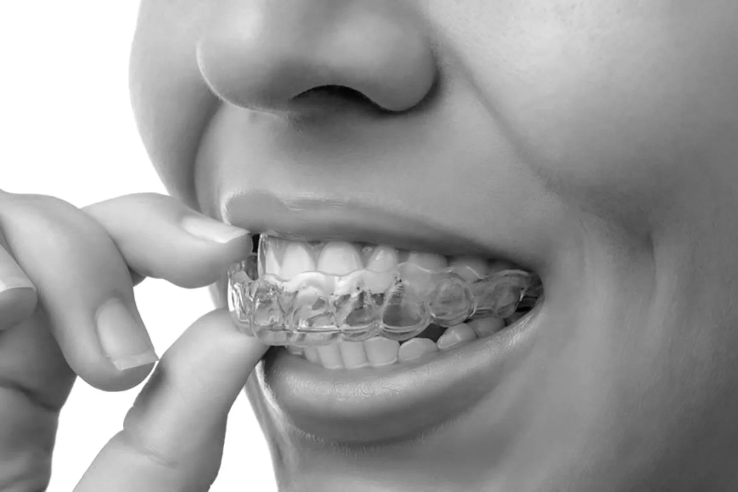 Hva er den forventede prisen for tannregulering for en voksen, og hvilke faktorer kan påvirke denne kostnaden?