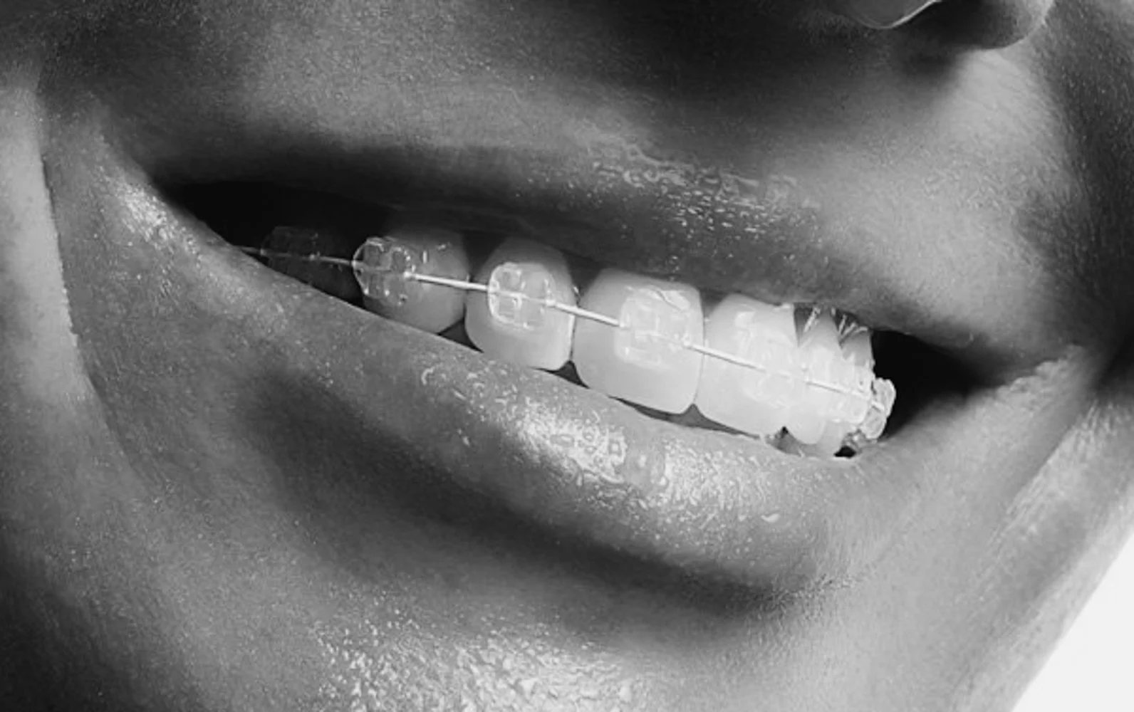 Hva koster tannregulering i gjennomsnitt for en voksen i Norge?