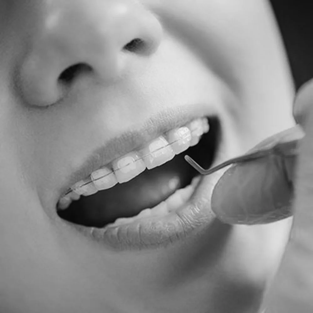 Hvordan kan jeg ta vare på mine gjennomsiktig tannregulering for å sikre best mulig resultat?