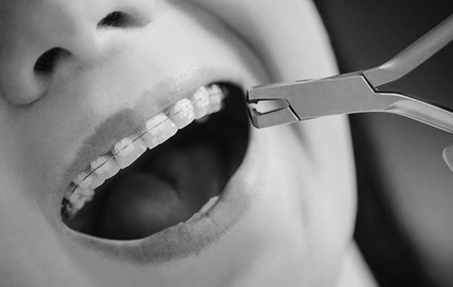 Kan voksne ha nytte av tannregulering, og hva er de vanligste typene?