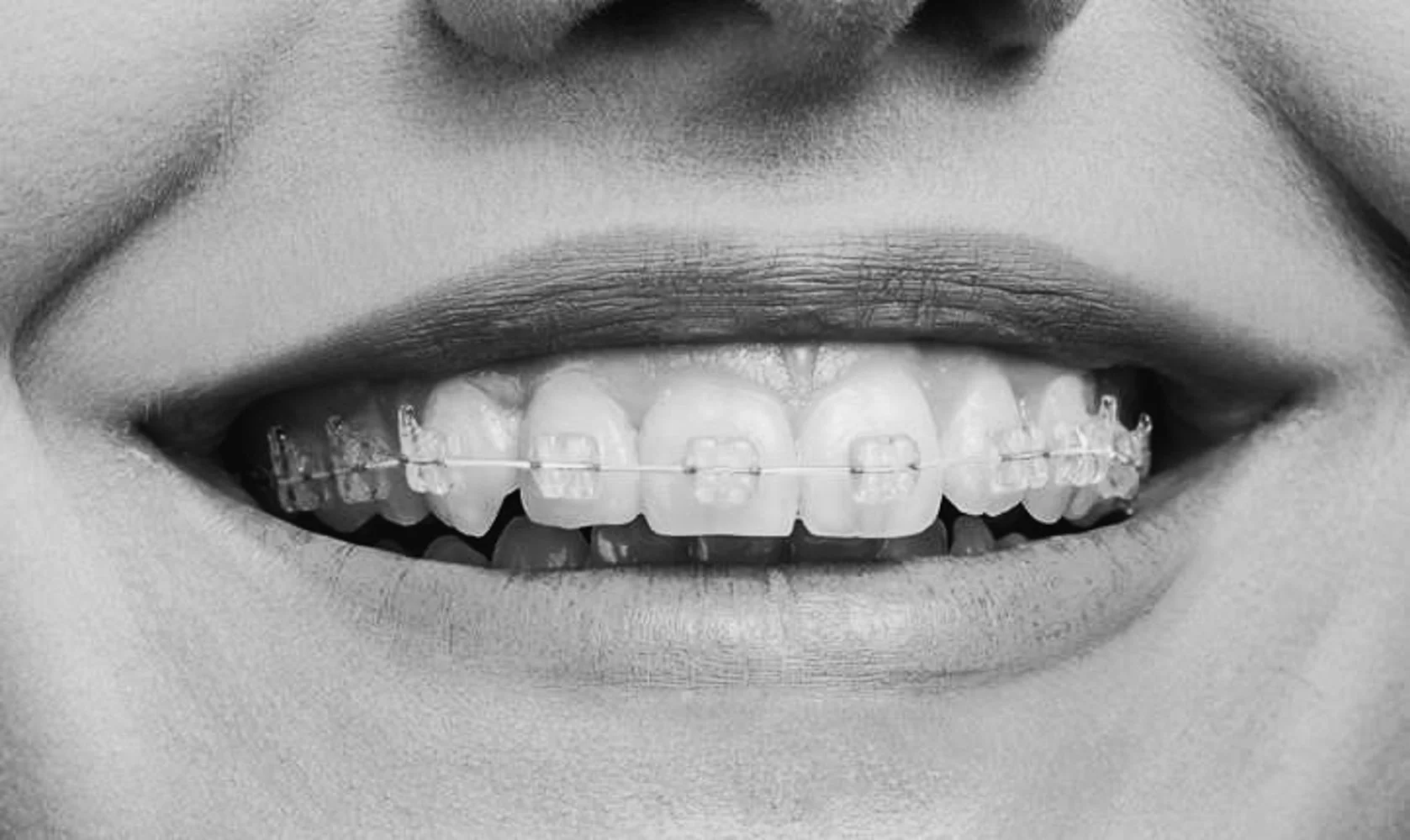 Hvor mye koster tannregulering for voksne sammenlignet med barn?