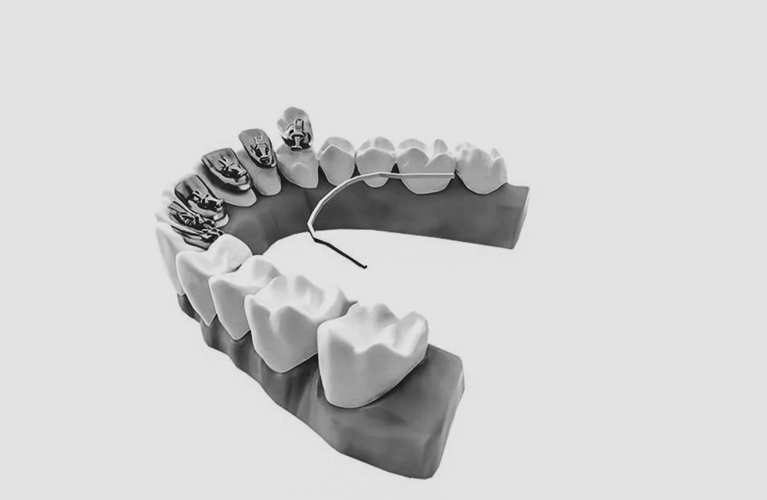 Hva er Incognito tannregulering, og hvordan skiller den seg fra andre usynlige reguleringer?