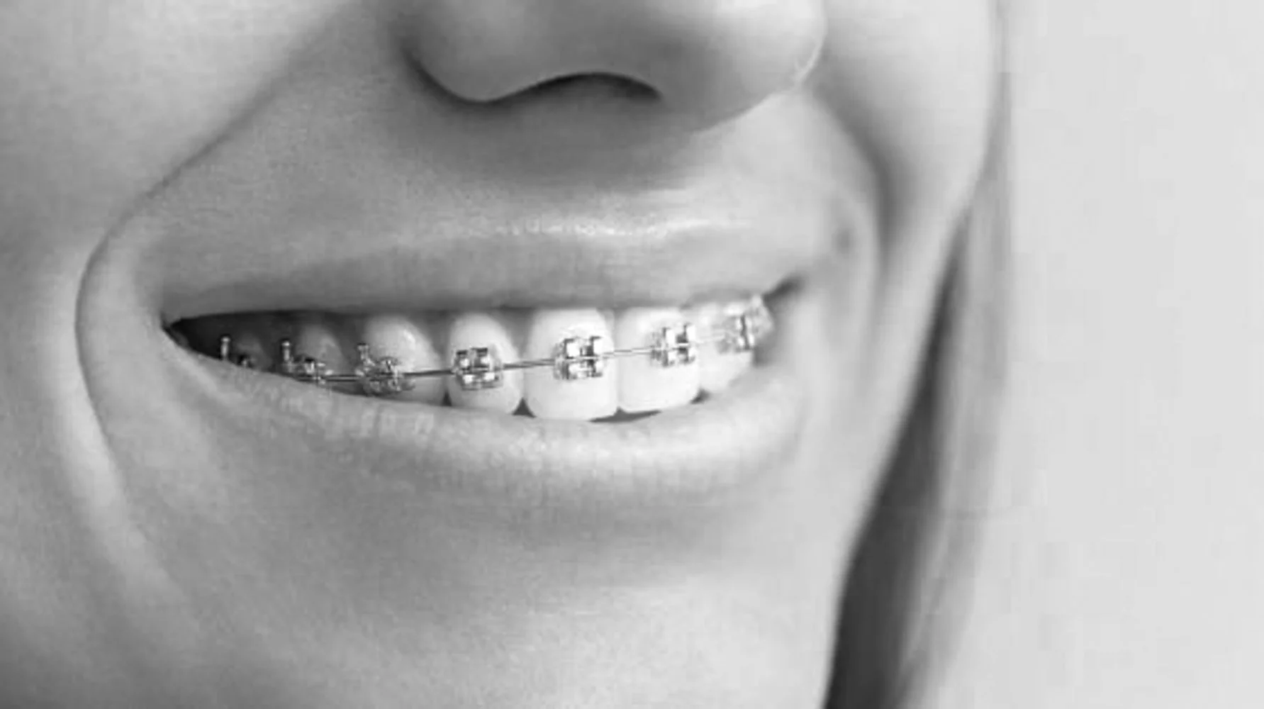 Hva er forskjellen mellom tradisjonell og gjennomsiktig tannregulering?