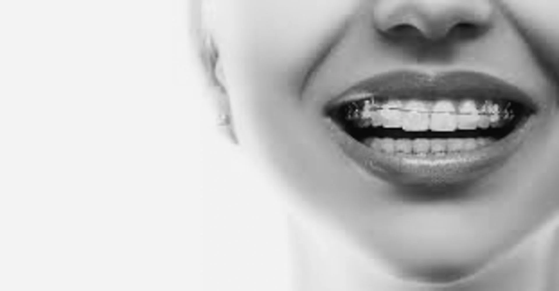 Hva er betydningen av "toppen tannregulering" innen ortodonti?