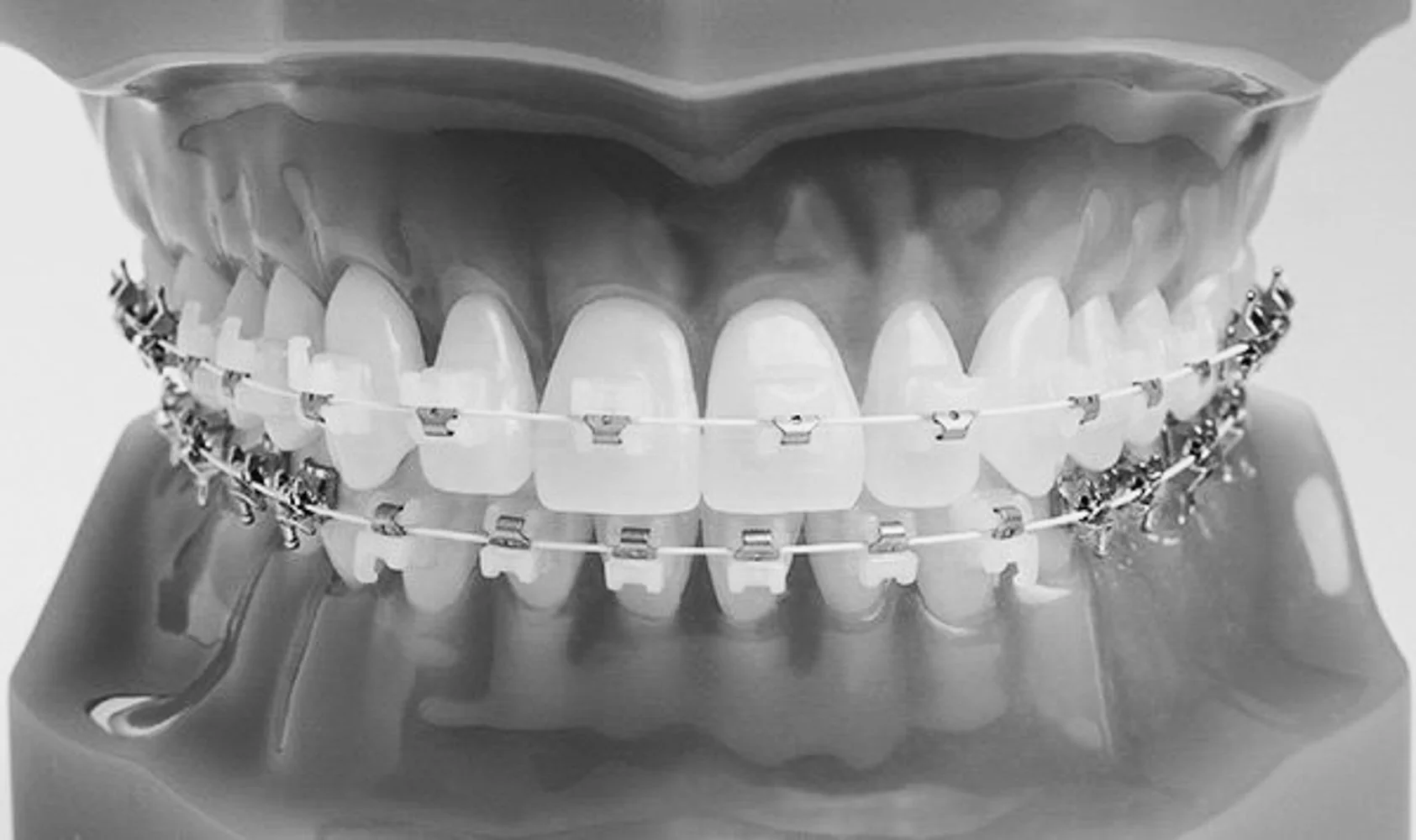 "Hvordan skiller "stord tannregulering" seg fra andre typer ortodontiske behandlinger?"