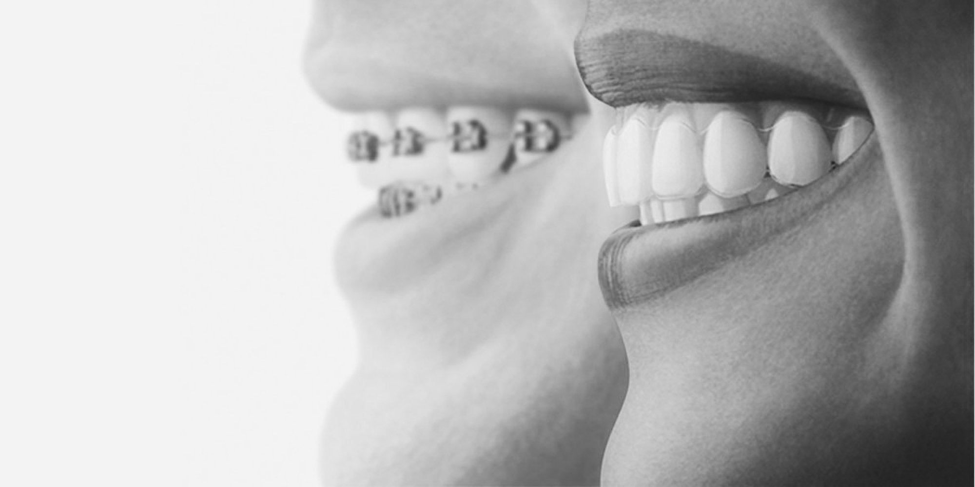 Tannregulering: Alt du trenger å vite