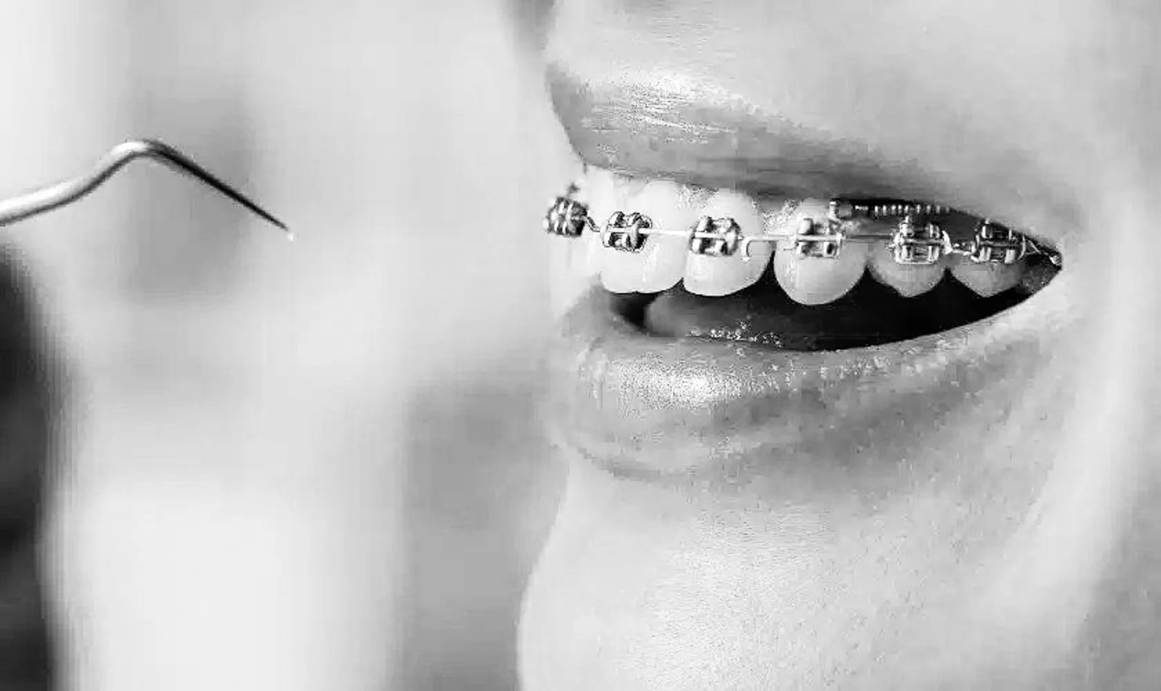 Hvor mye tannregulering pris voksen seler i gjennomsnitt?