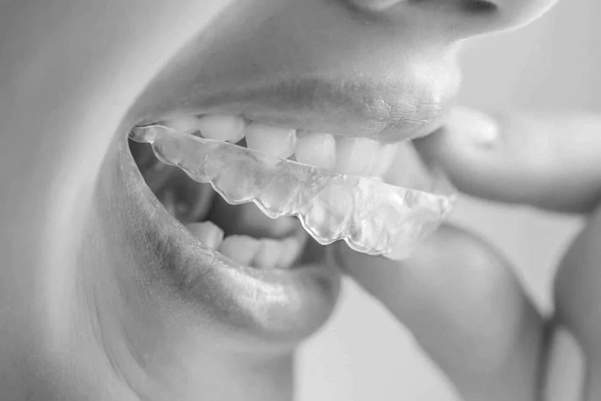 Kan Tannregulering forårsake Tilbaketrekning av Tannkjøttet? En Omfattende Oversikt