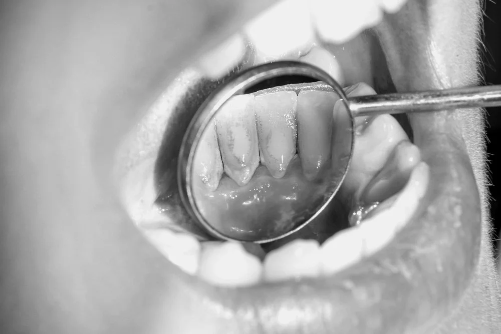 En Guide til Fjerning av Tannstein og Plakk med Tannrenser