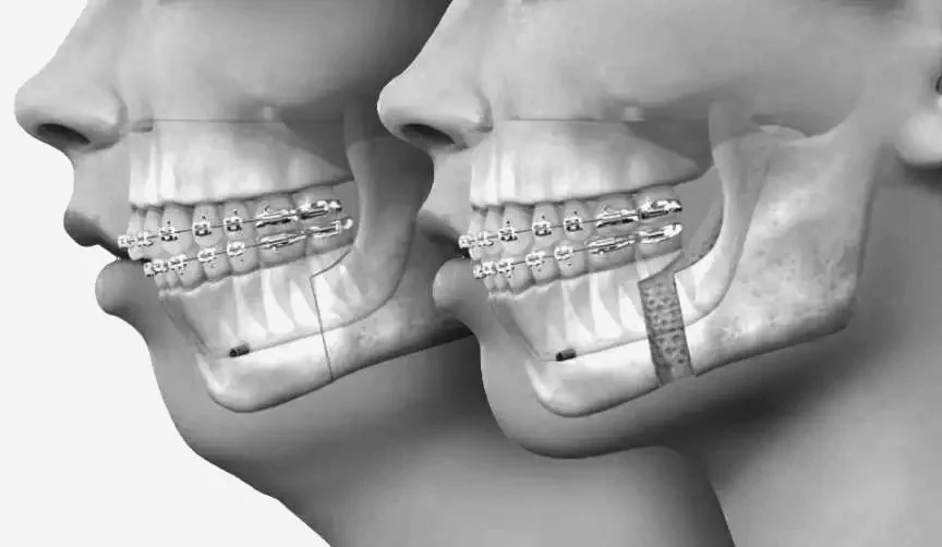 Kjevekirurgi: Hva du kan forvente og hvordan du forbereder deg