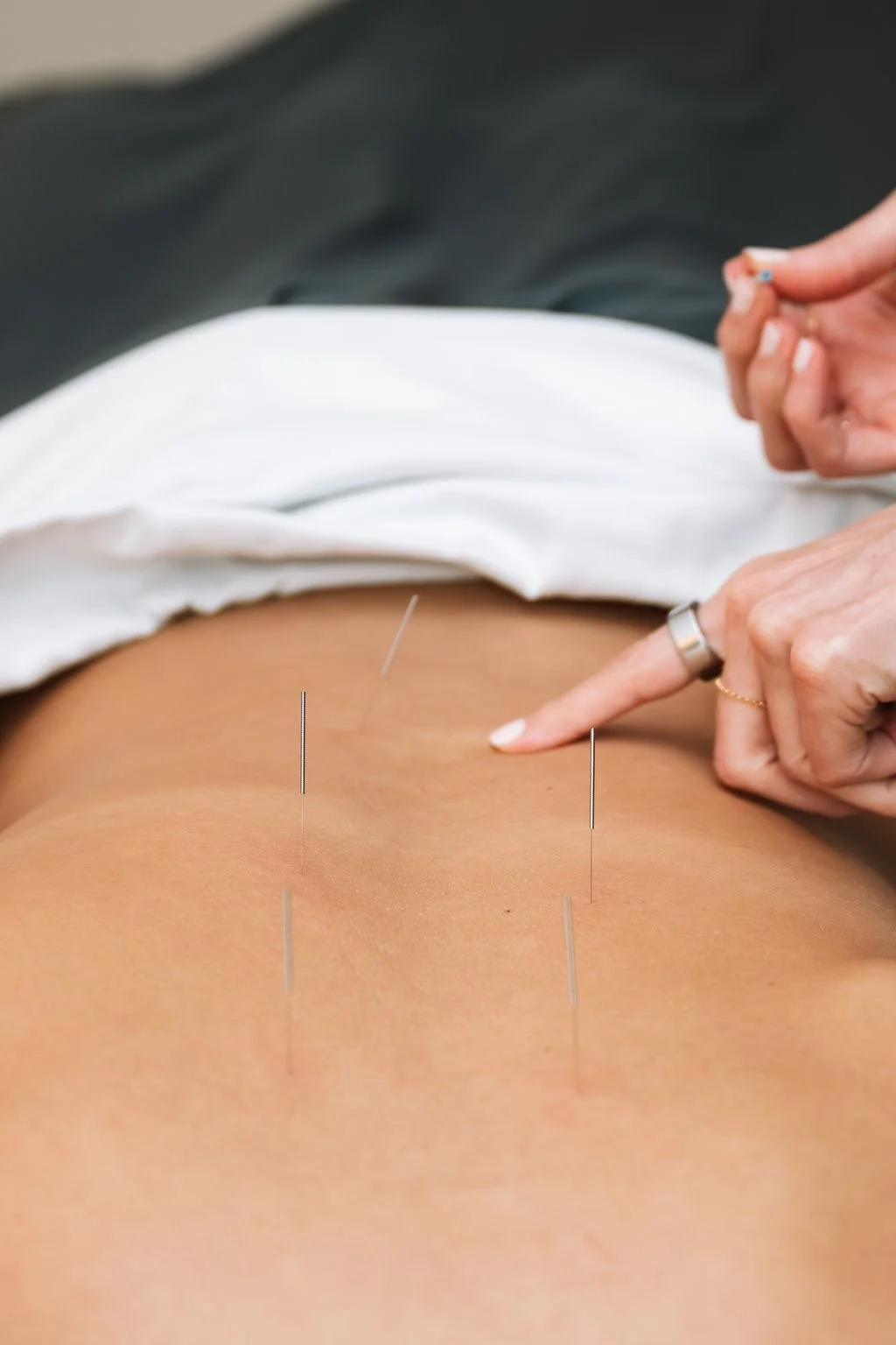 patient receiving body acupuncture