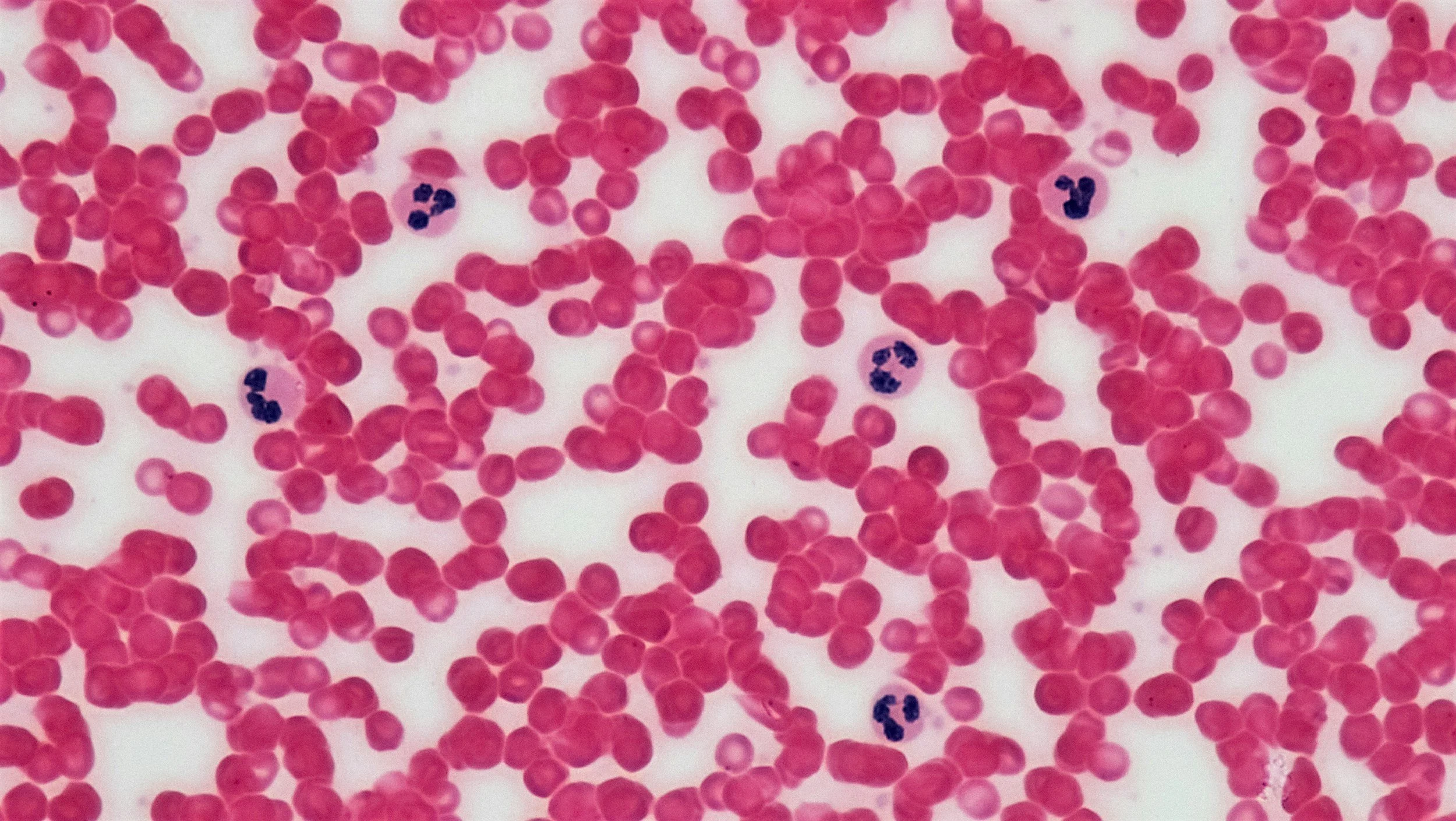Lyme Disease vs. Babesia: What’s the Difference — Could You Have Both?