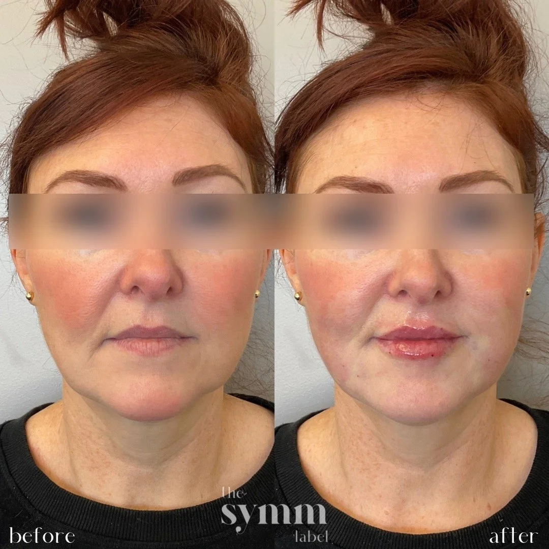 lower face filler - lips, chin & chin shadow