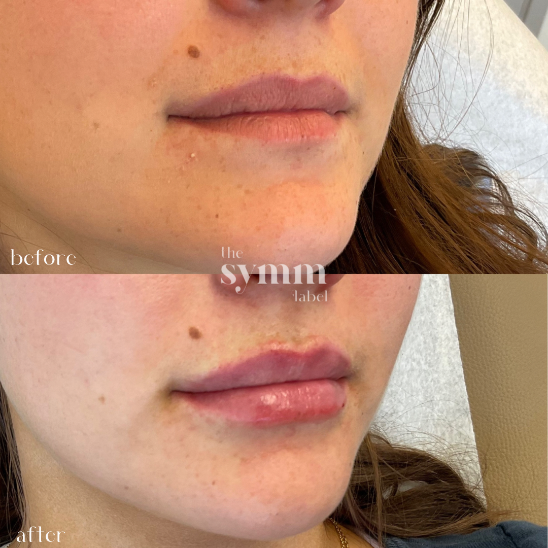 lip filler