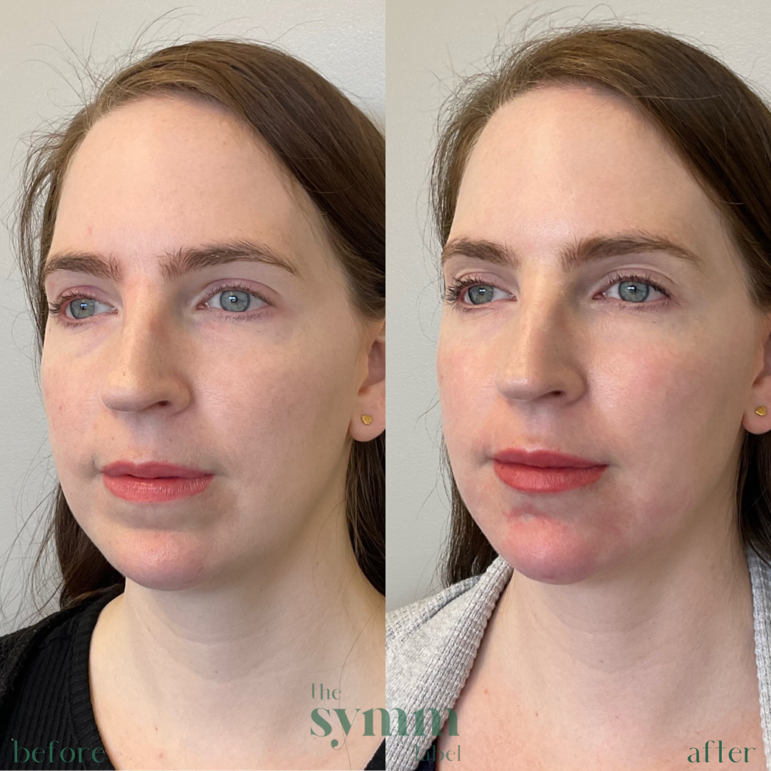 trifecta - lip, chin & chin shadow filler