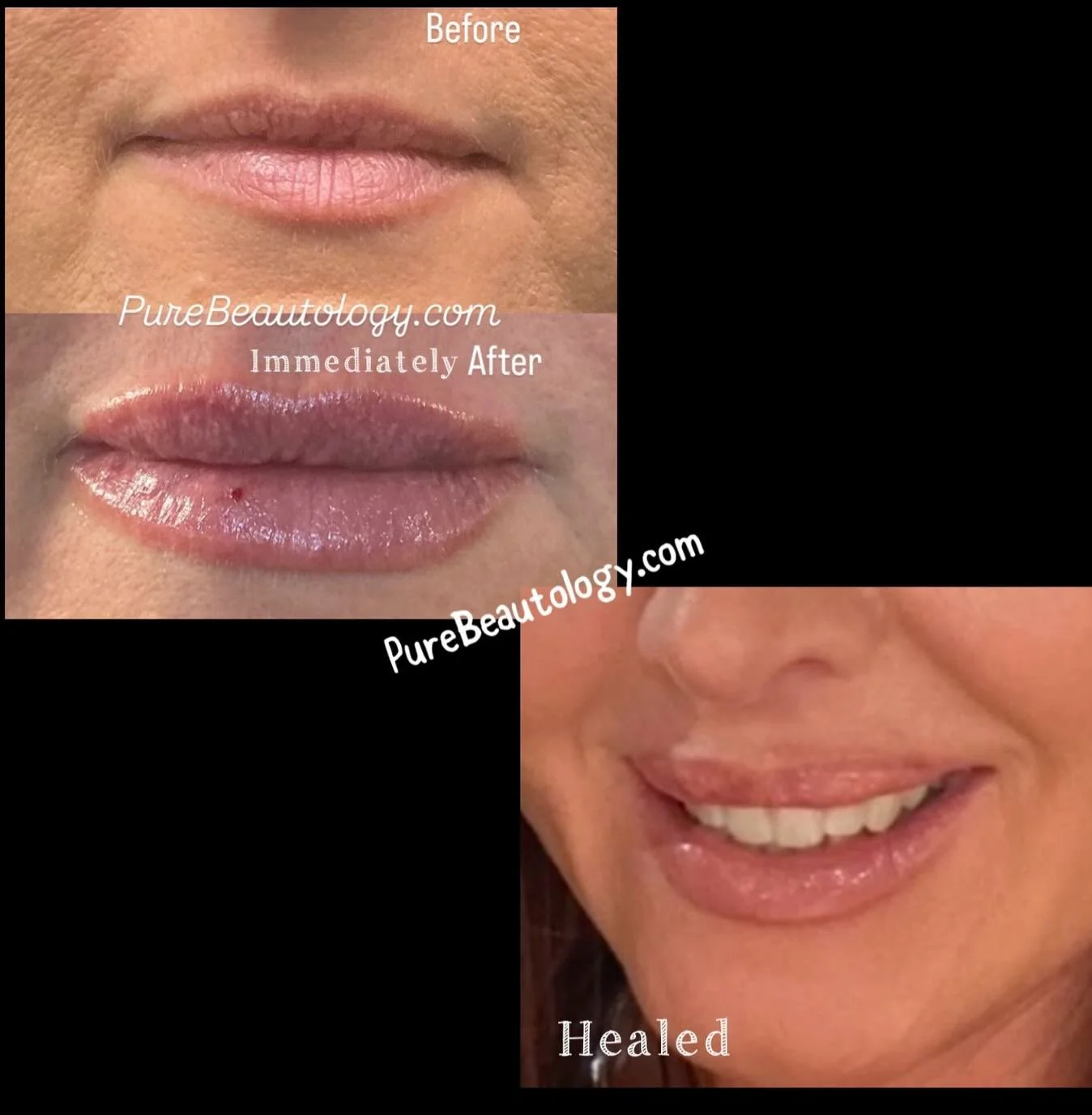 These beautiful lips don&rsquo;t lie! 

Have you been thinking about naturally enhancing your lips? There&rsquo;s no better way to bring in the New Year than with the most kissable lips. 

PureBeautology.com