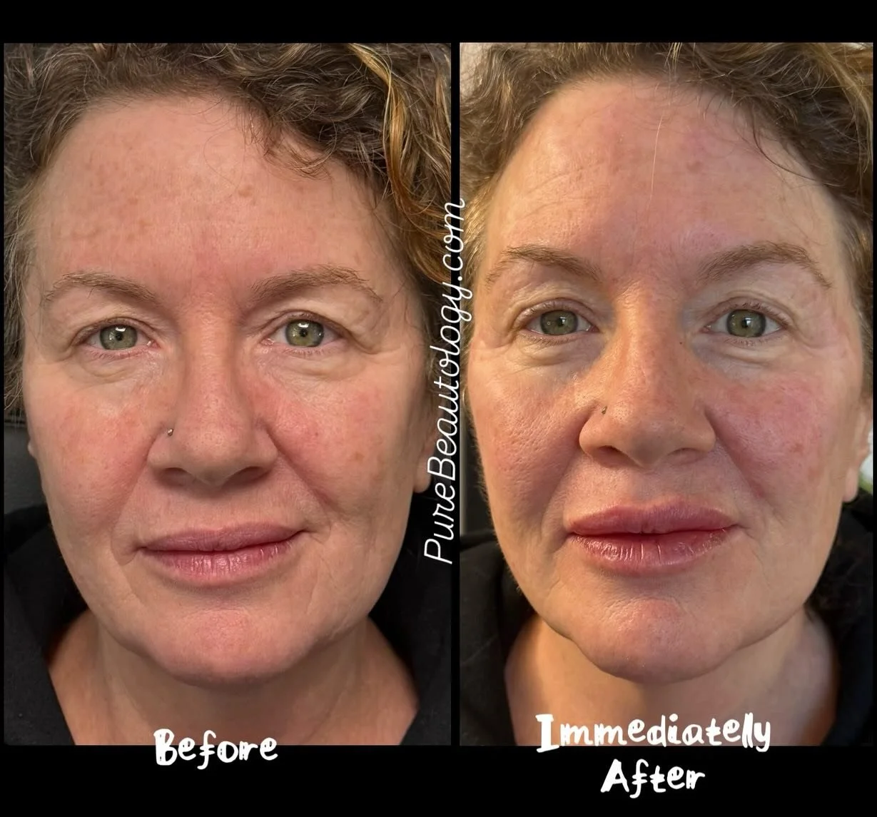 I&rsquo;m just a girl who loves to make other girls feel beautiful. 

Call Yvonne RN for a consultation. 

PureBeautology.com