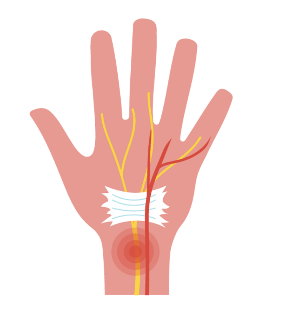 Wrist Pain, Numbness or Tingling? When It Could Be Carpal Tunnel Syndrome