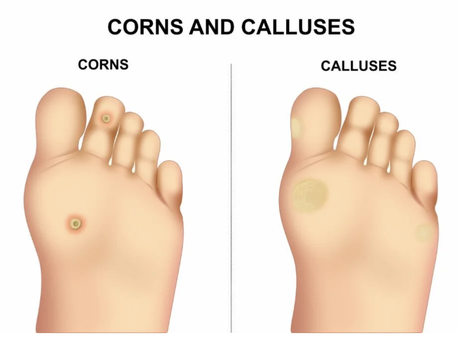 Medical Illustration of Corns and Calluses on feet